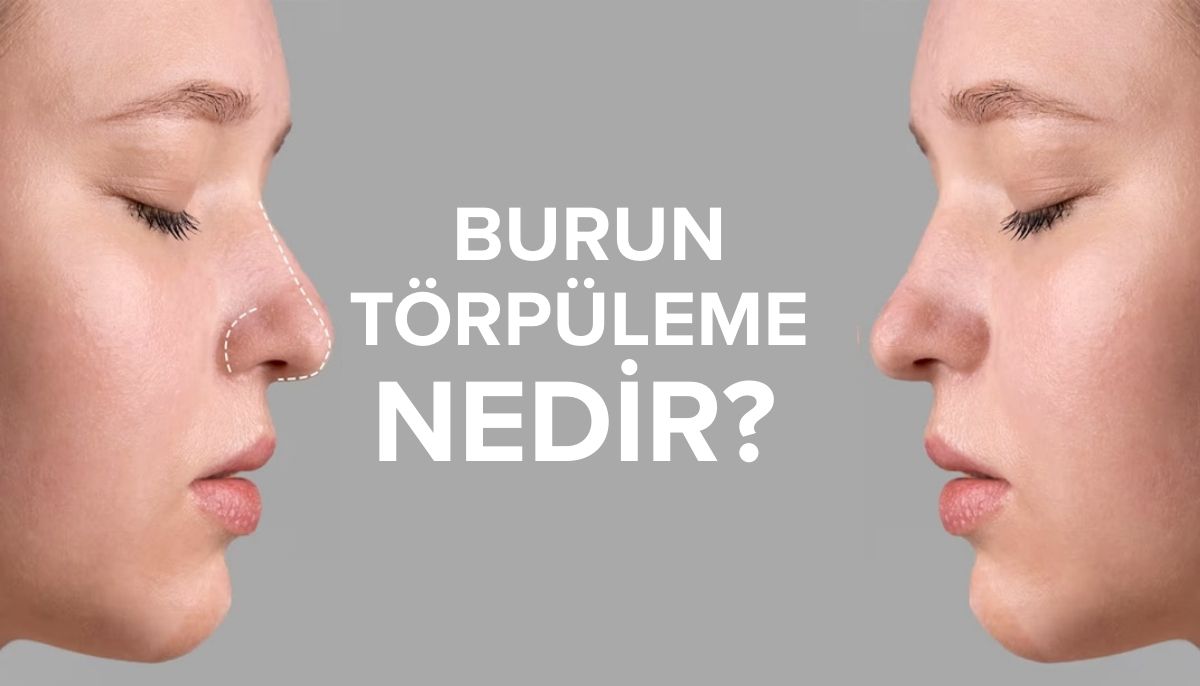 Burun Törpüleme Nedir?